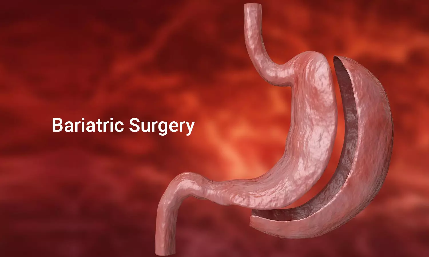 Bariatric Surgery (Weight Loss) – A Complete Guide For Patients