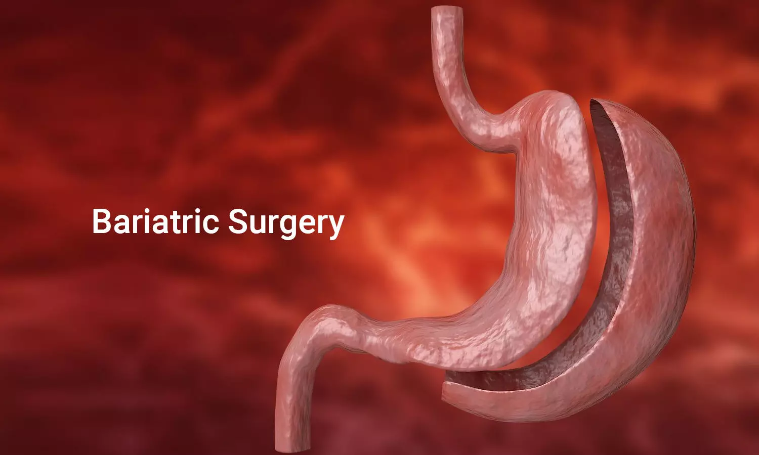 bariatric-surgery