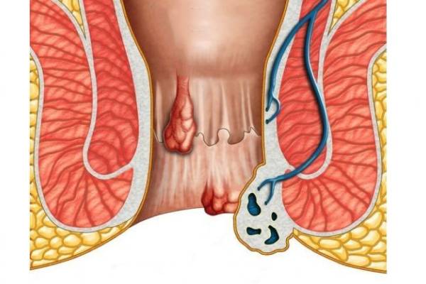 Fissures Fistula