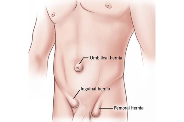 Hernia