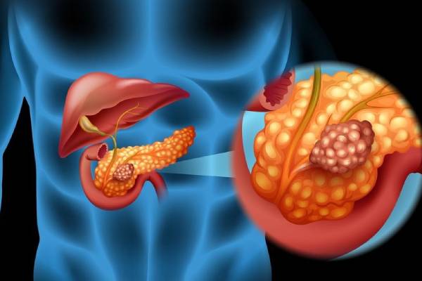 Pancreatic-Cance