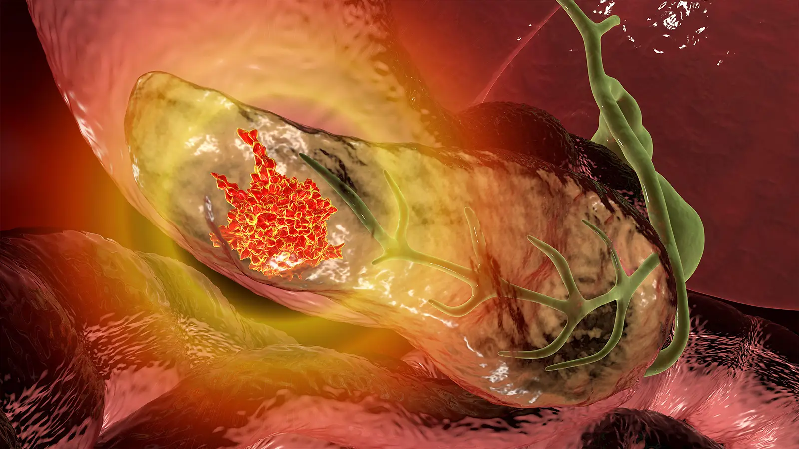Pancreatic Cancer Treatment in Pimpri Chinchwad